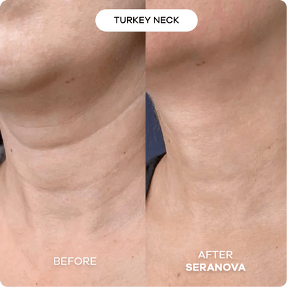 The Micro Infusion System™